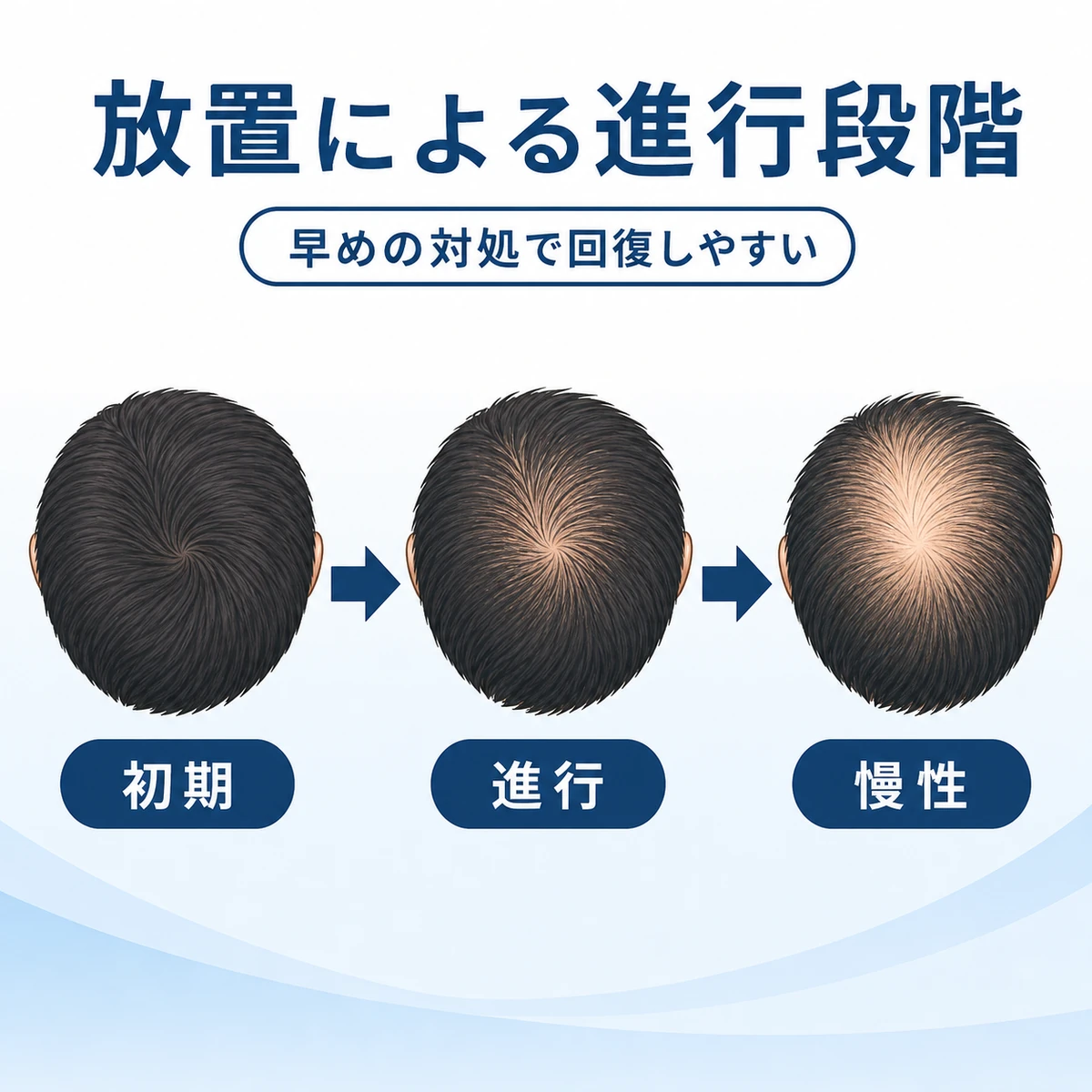 抜け毛を放置した場合の薄毛の進行段階を左から右へ表した医療イラスト