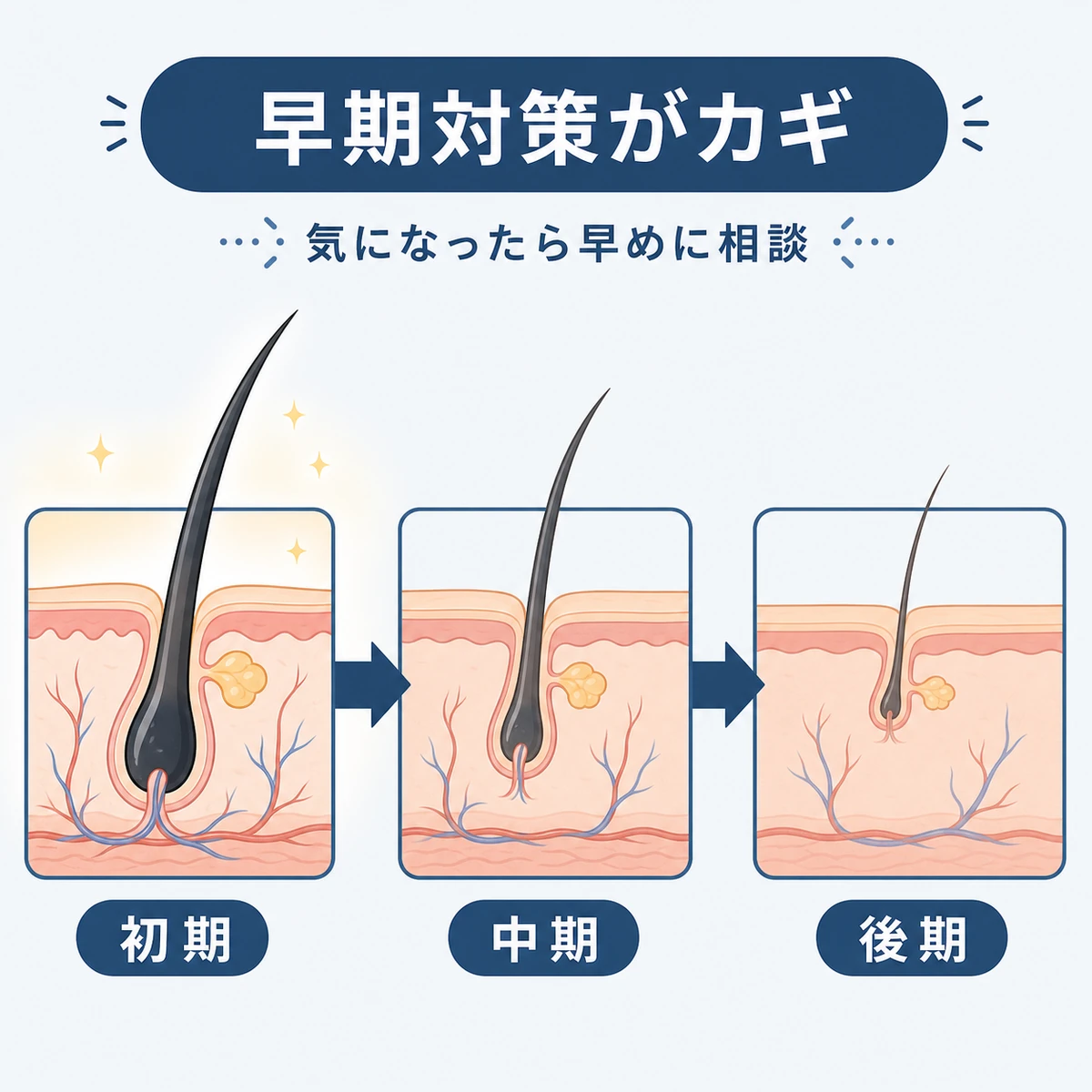 毛根の状態が初期から後期へ変化する様子を段階で表した若ハゲ治療の医療イラスト