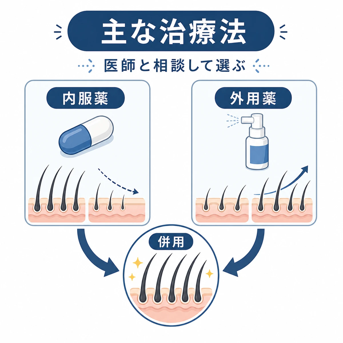 内服薬と外用薬を組み合わせるAGA治療の仕組みを表した医療イラスト
