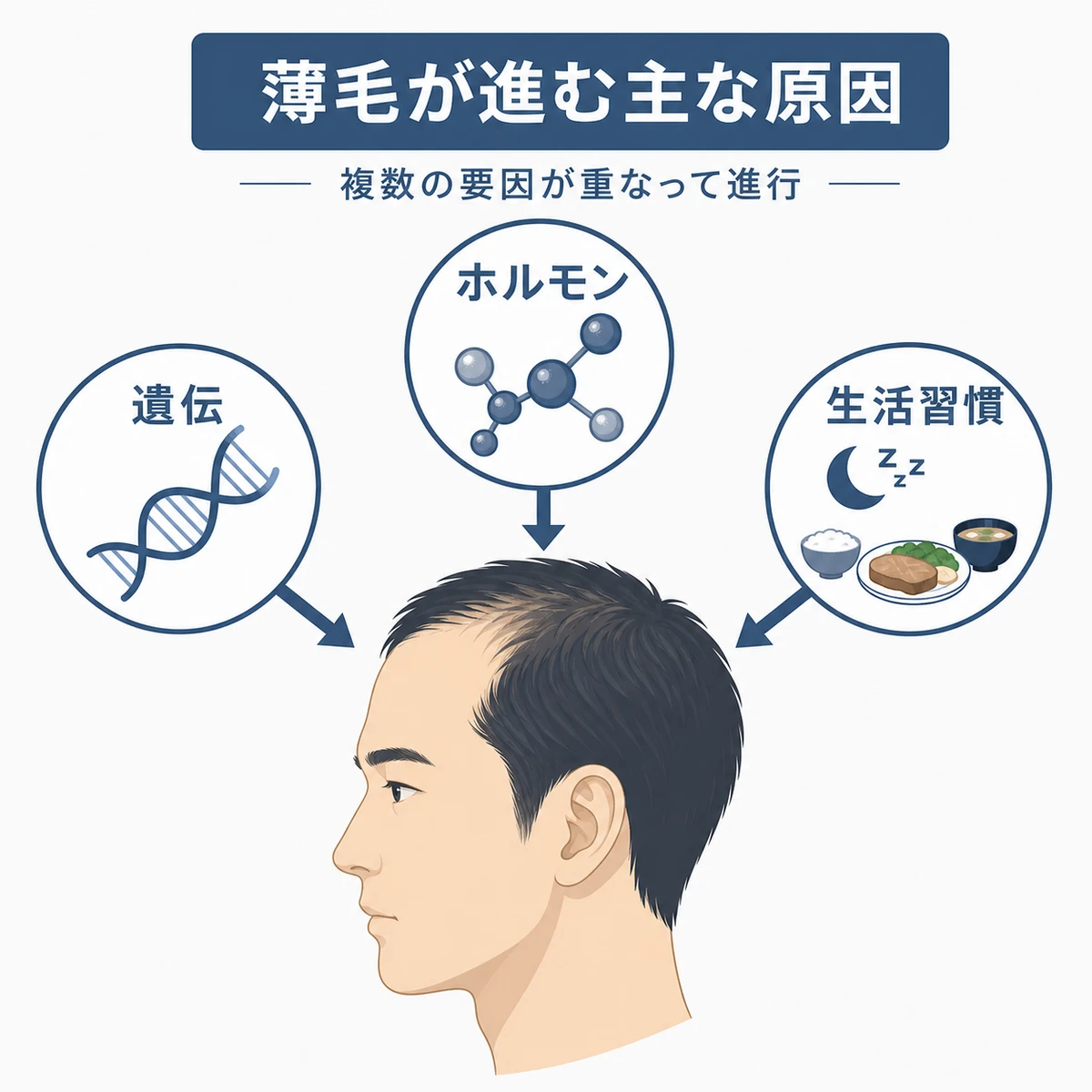 遺伝・男性ホルモン・生活習慣が重なって30代男性の薄毛が進む仕組みを表した医療イラスト