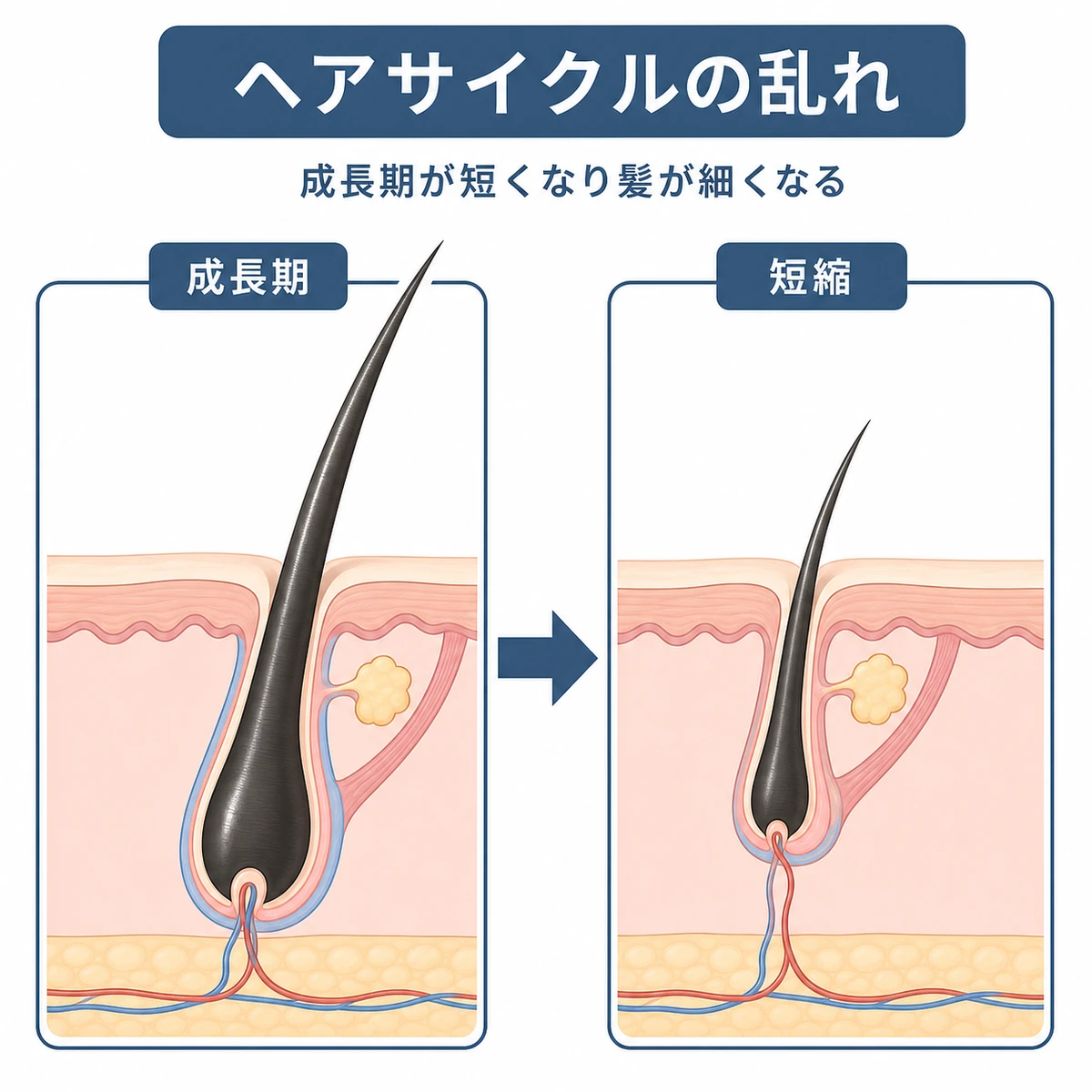 AGAで髪の成長期が短くなりヘアサイクルが乱れて毛が細くなる変化を表した医療イラスト