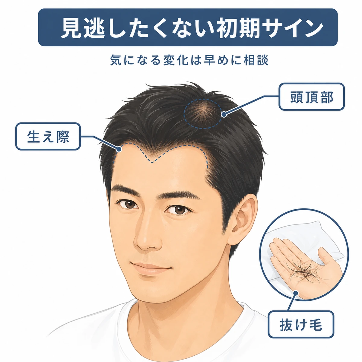 30代男性の薄毛の初期サインを生え際や頭頂部など部位ごとに示した医療イラスト
