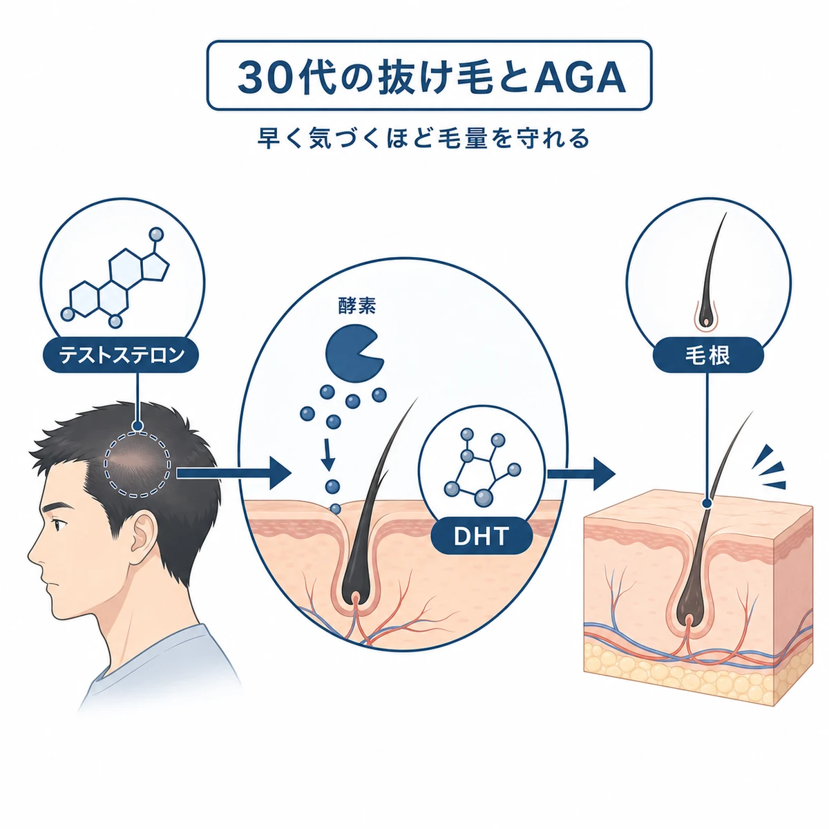 男性ホルモンからDHTが作られ毛根に作用する仕組みを表した医療イラスト