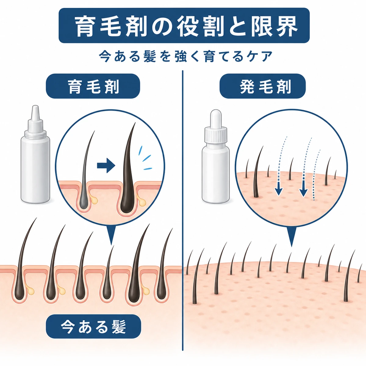 育毛剤と発毛剤の役割の違いを左右で対比した医療イラスト