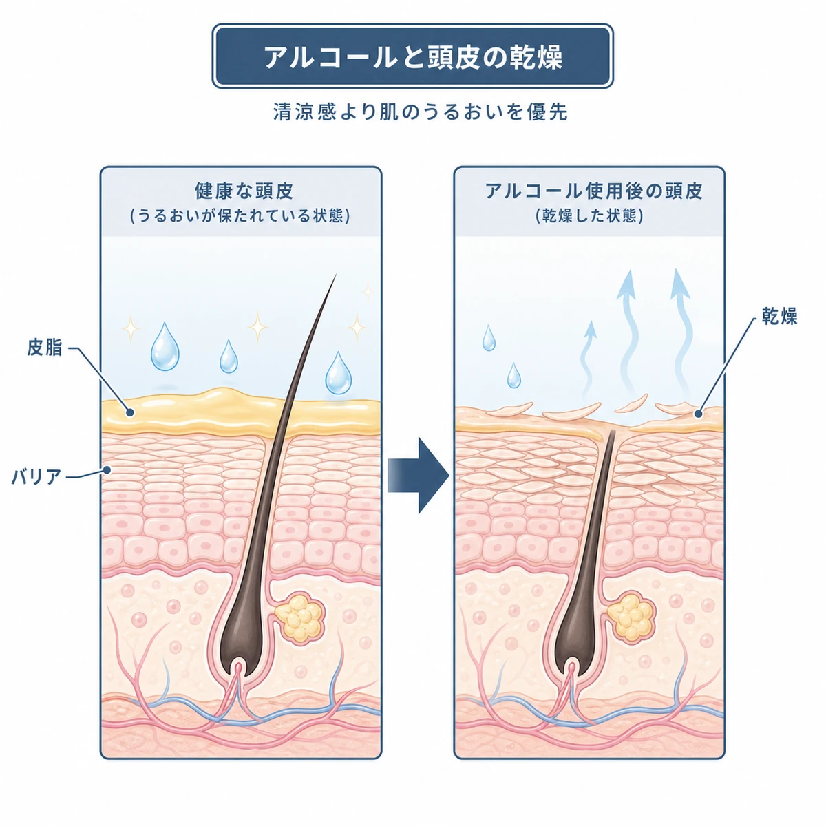 アルコールにより頭皮の皮脂とうるおいが失われていく断面の変化を表した医療イラスト