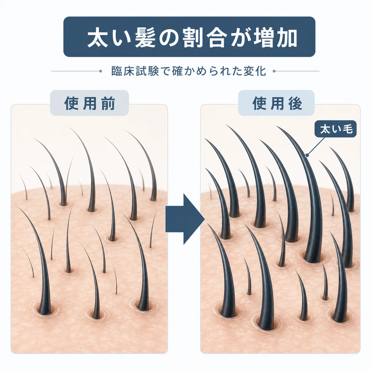 外用アデノシンの使用前後で頭皮の毛が細い状態から太い状態へ変わる様子を表した医療イラスト