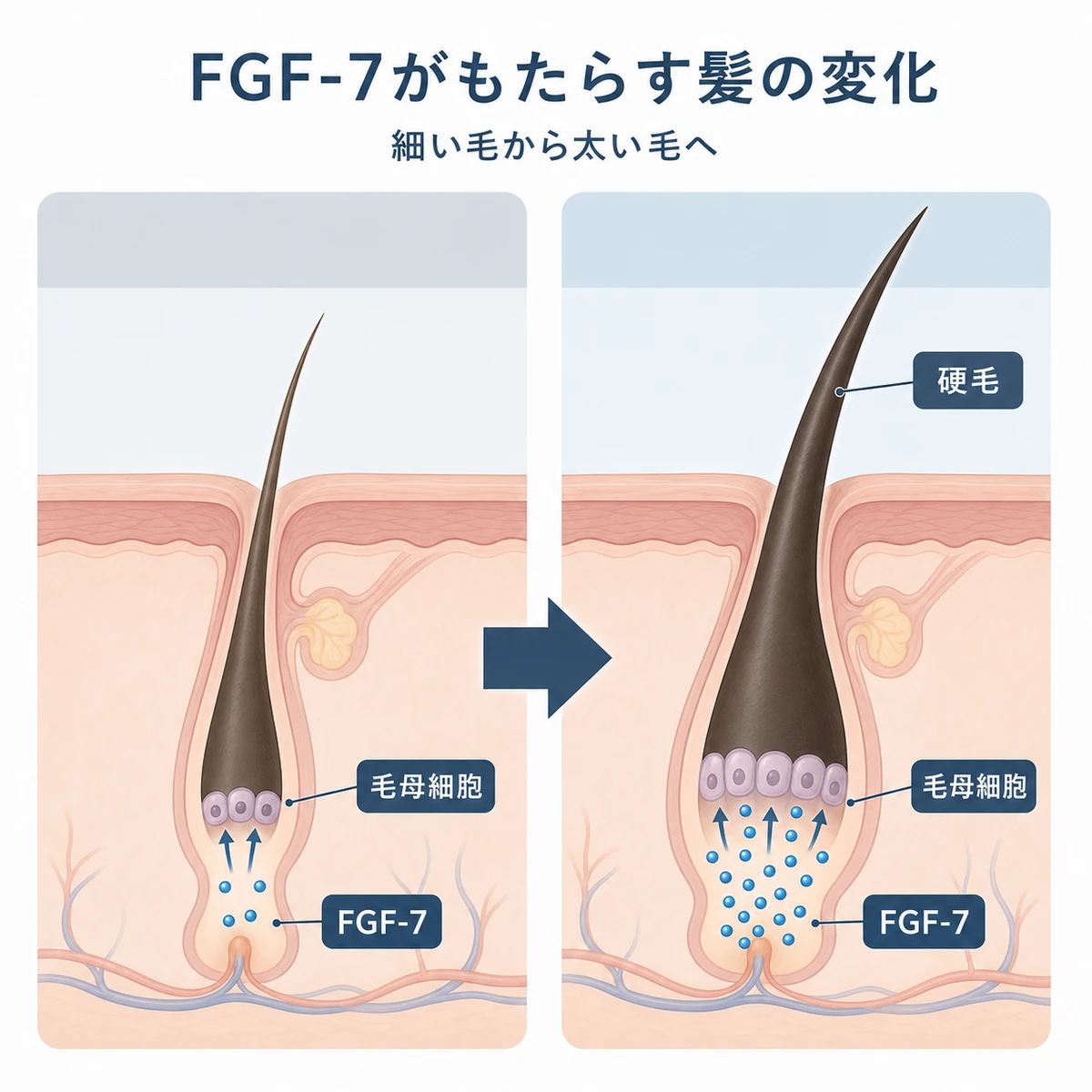 FGF-7が増えることで細い軟毛から太い硬毛へ変わる違いを表した医療イラスト