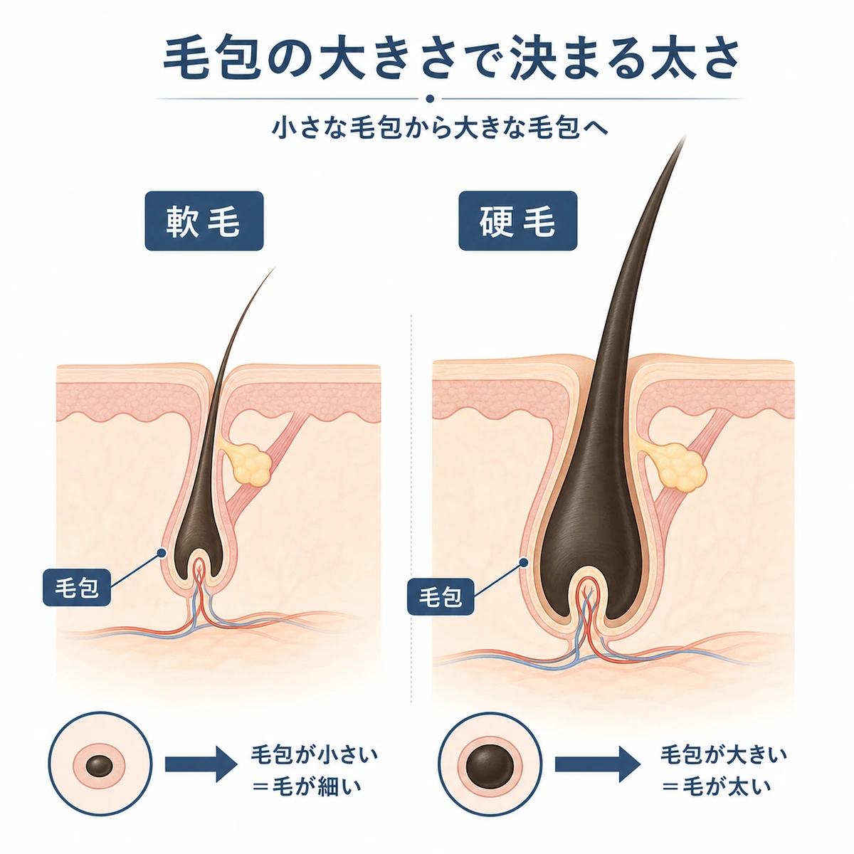 毛包の大きさによって髪の太さが変わる仕組みを軟毛と硬毛で比べた医療イラスト