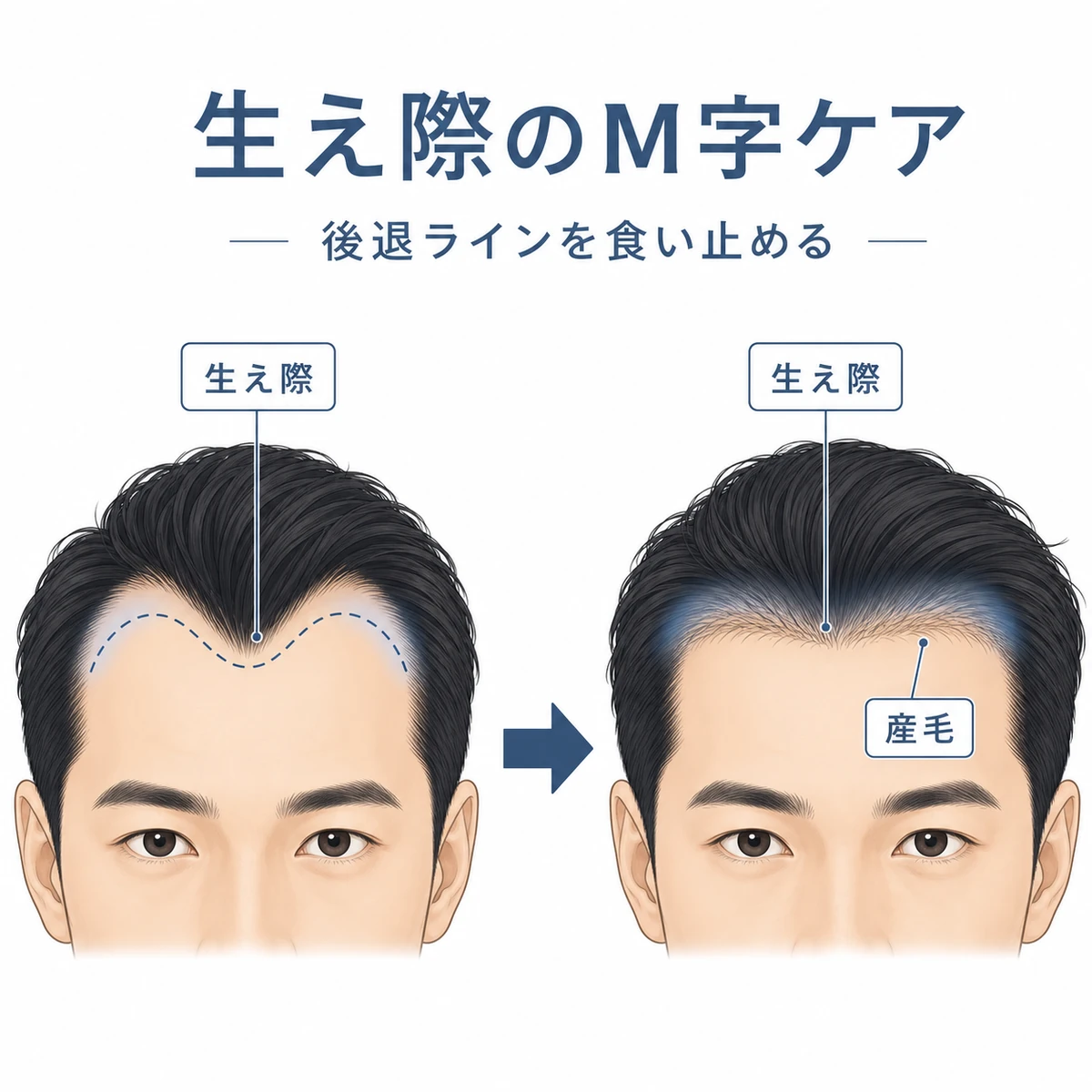 M字部分の生え際が産毛の増加で濃くなっていく変化を表した医療イラスト