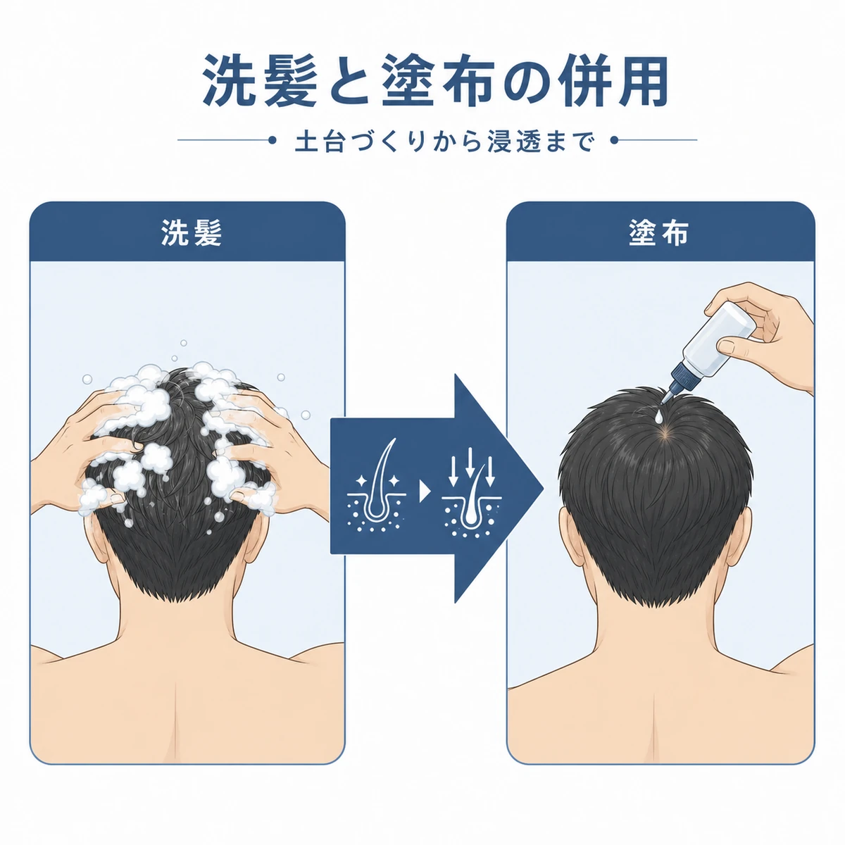 洗髪のあとに育毛ローションを塗布して併用する流れを表した医療イラスト