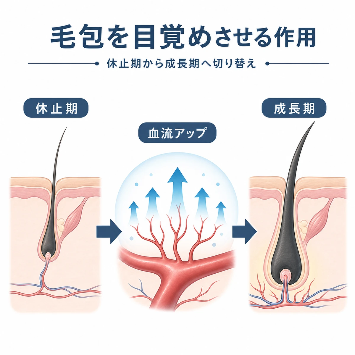 ミノキシジルが休止期の毛包を血流促進とともに成長期へ移行させる流れを表した医療イラスト