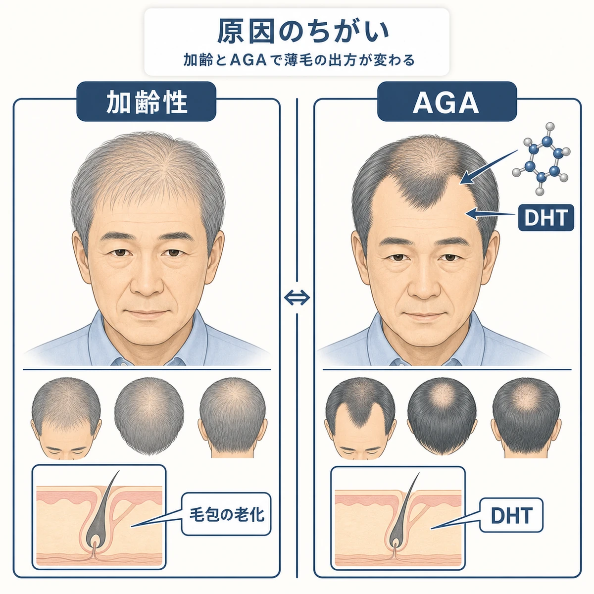 加齢性の薄毛とAGAで抜け毛の原因とパターンが異なることを左右で対比した医療イラスト