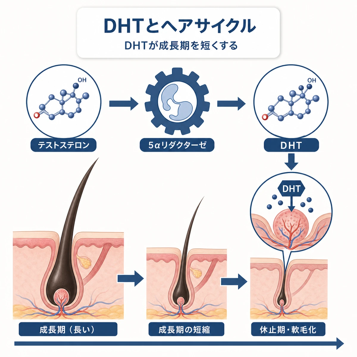 テストステロンがDHTに変換され毛乳頭に作用してヘアサイクルの成長期を短くする流れを表した医療イラスト