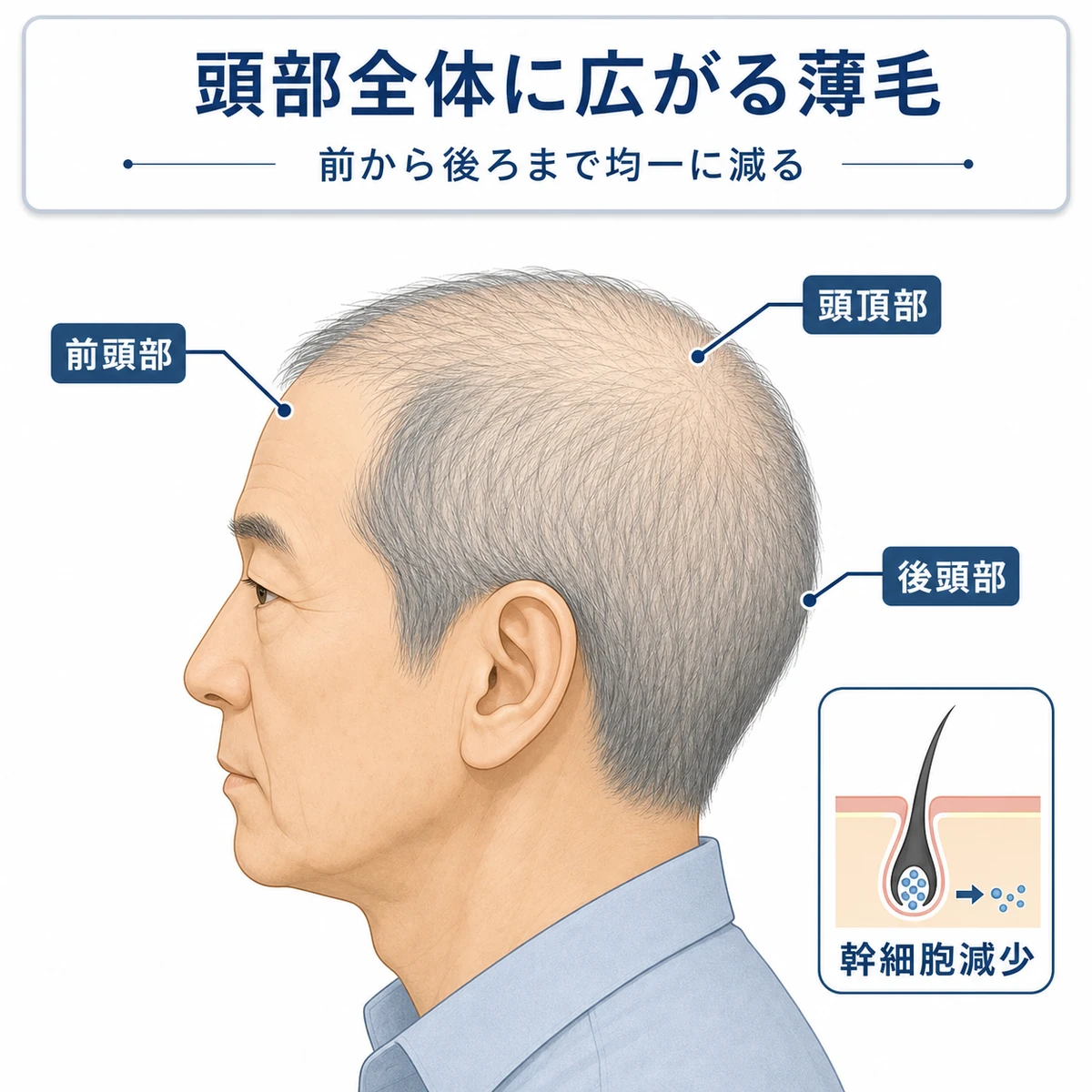 老人性脱毛症で頭部全体が均一に薄くなる様子を側面から表した医療イラスト