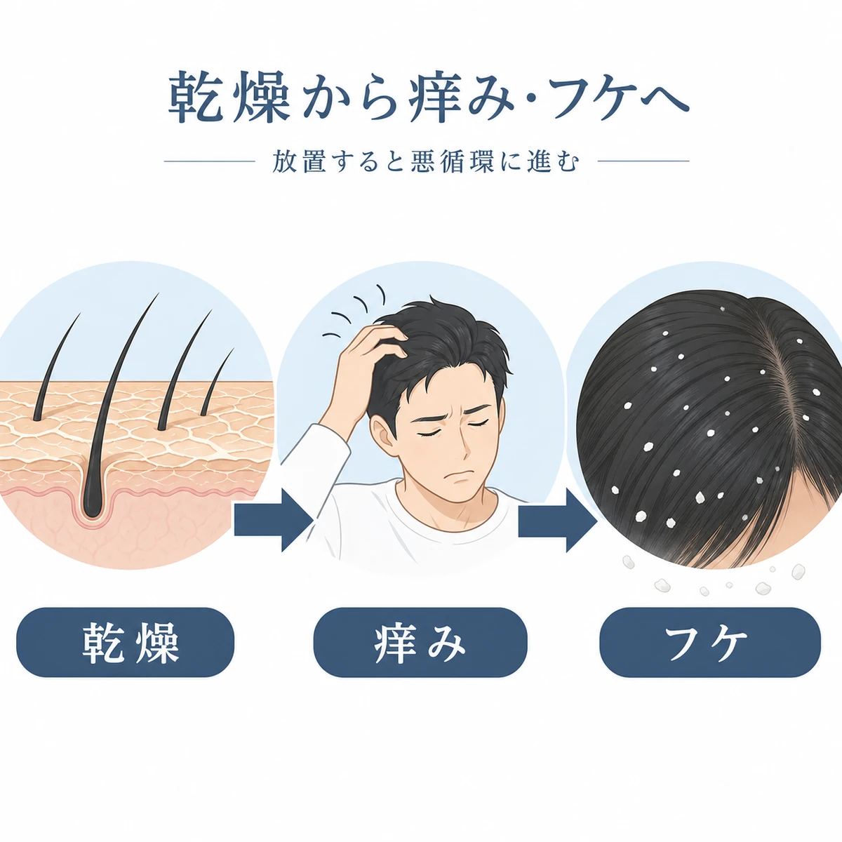 頭皮の乾燥が痒みやフケへと進行する流れを左から右に示した医療イラスト