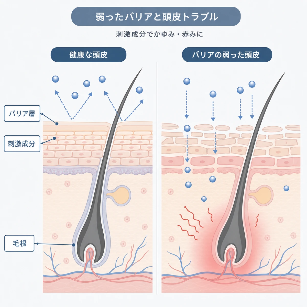 健康な頭皮とバリア機能が弱った頭皮の断面を比べた医療イラスト