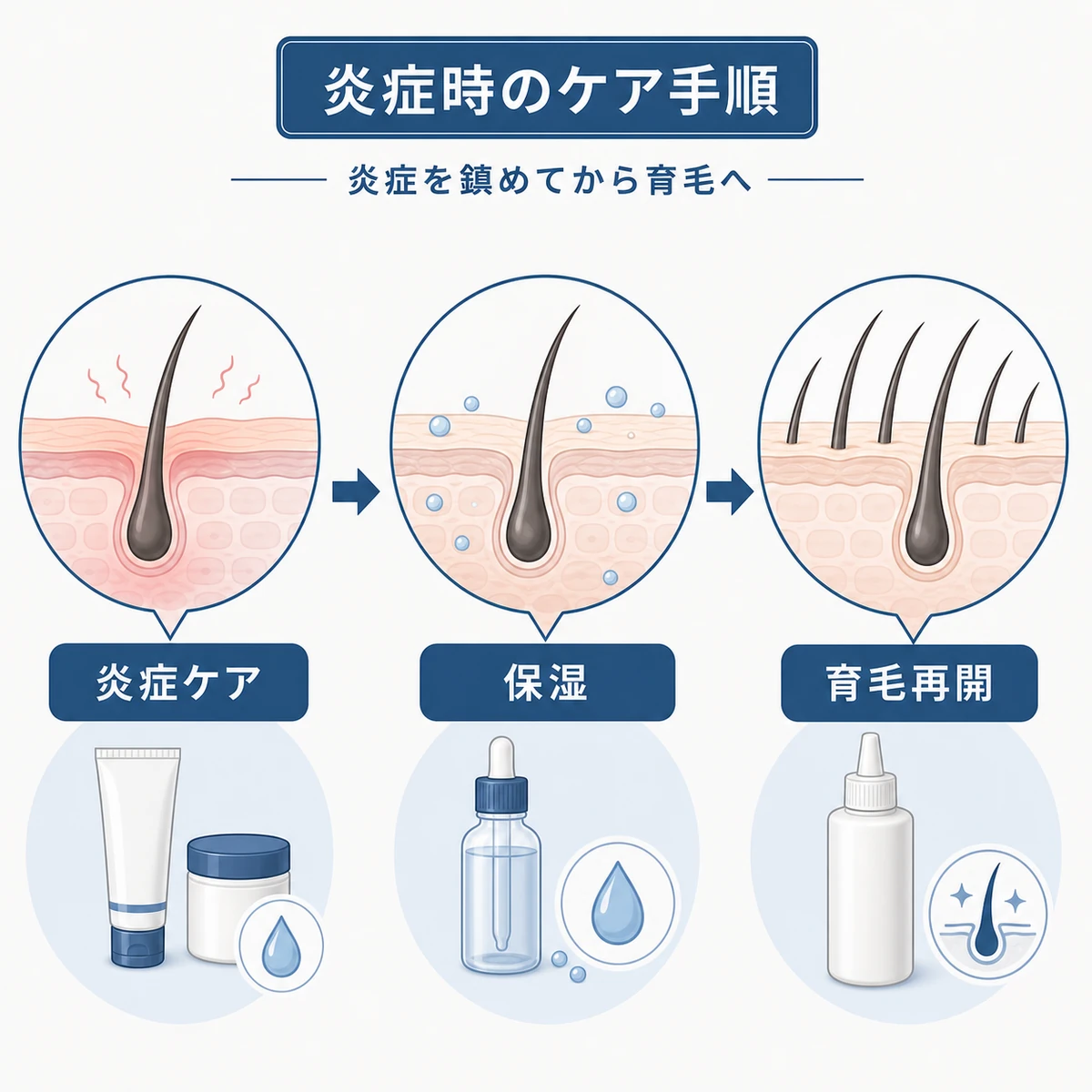 頭皮の炎症を鎮めてから育毛ケアを再開する流れをタイムラインで表した医療イラスト