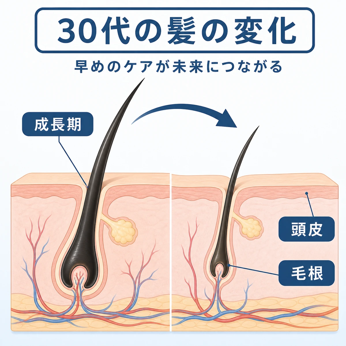 30代男性の頭皮とヘアサイクルの変化を毛根の断面で表した医療イラスト