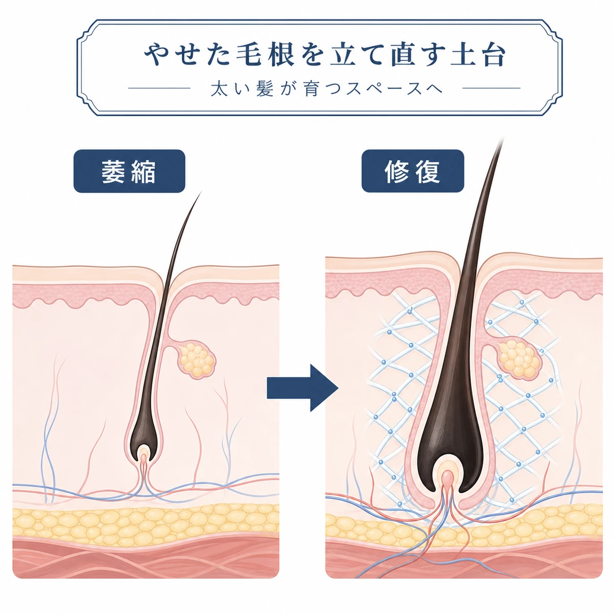 萎縮した毛根が土台修復で立て直される変化を表した医療イラスト