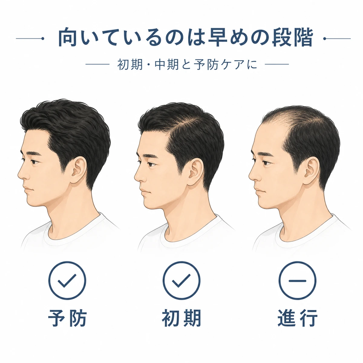キャピキシルが向いている薄毛の段階を表した医療イラスト