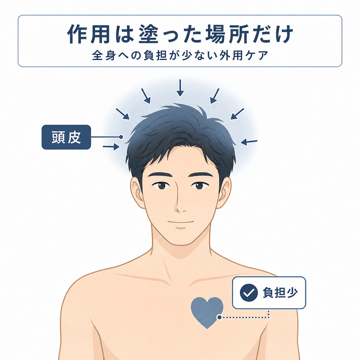 頭皮の塗布部だけに作用し全身への負担が少ない外用ケアを男性の姿で表した医療イラスト