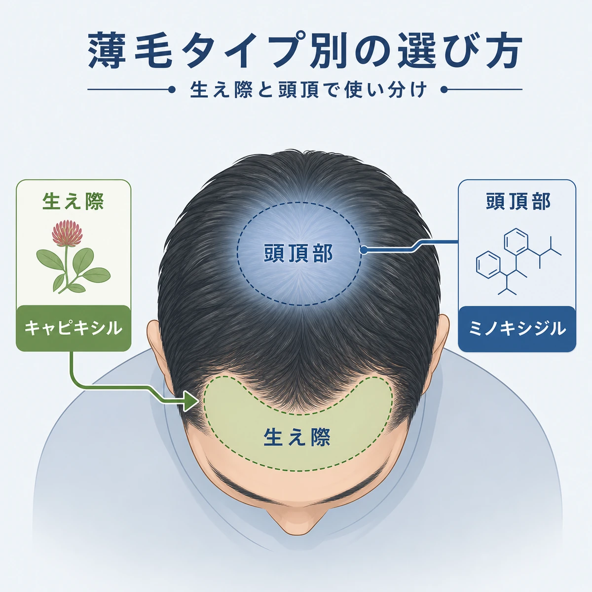 生え際と頭頂部の薄毛タイプ別に成分を使い分ける考え方を表した医療イラスト