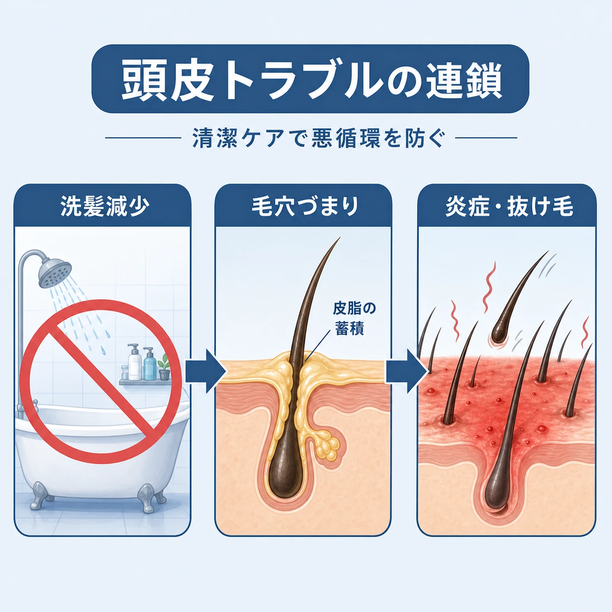 介護環境で洗髪が減り毛穴づまりから炎症・抜け毛へ進む頭皮トラブルの連鎖を表した医療イラスト