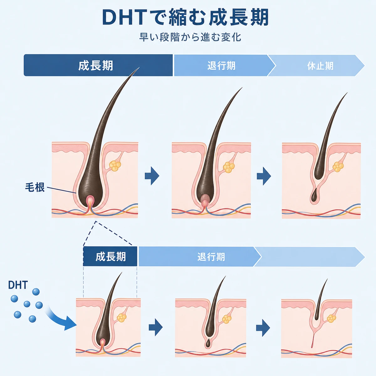 男性ホルモンDHTが毛髪の成長期を短縮させるヘアサイクルの変化を表した医療イラスト