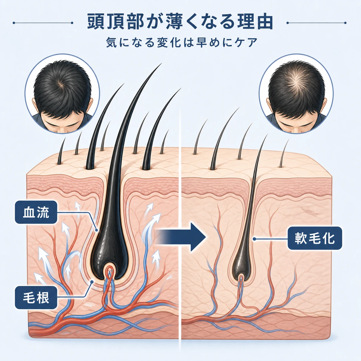 頭頂部の血流不足と髪の軟毛化が進むしくみを表した医療イラスト