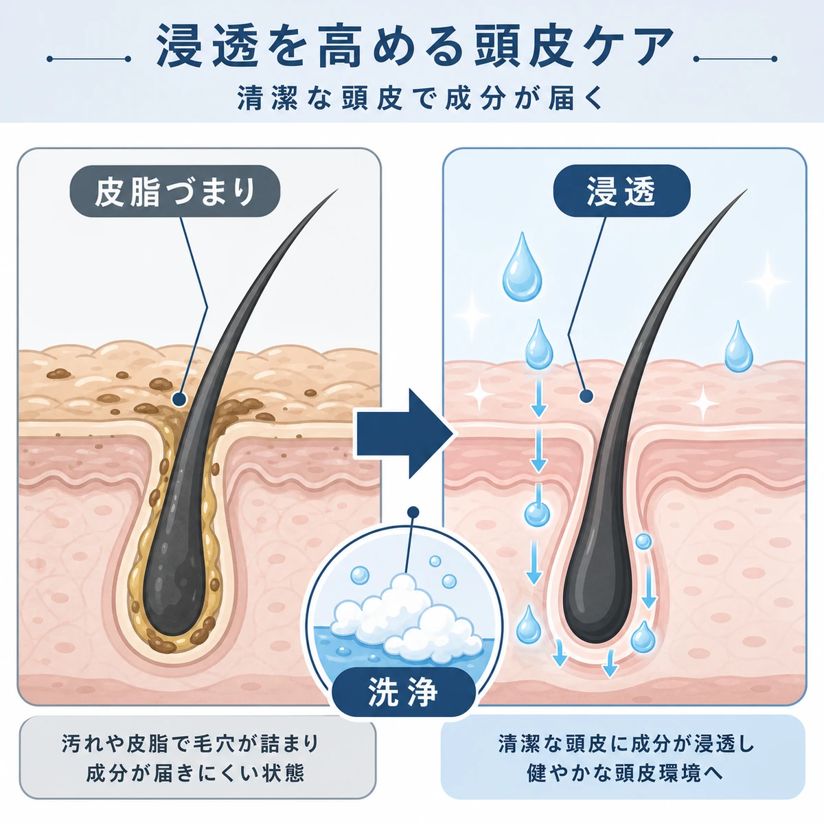 毛穴の汚れを落として育毛成分が浸透するまでの変化を表した医療イラスト