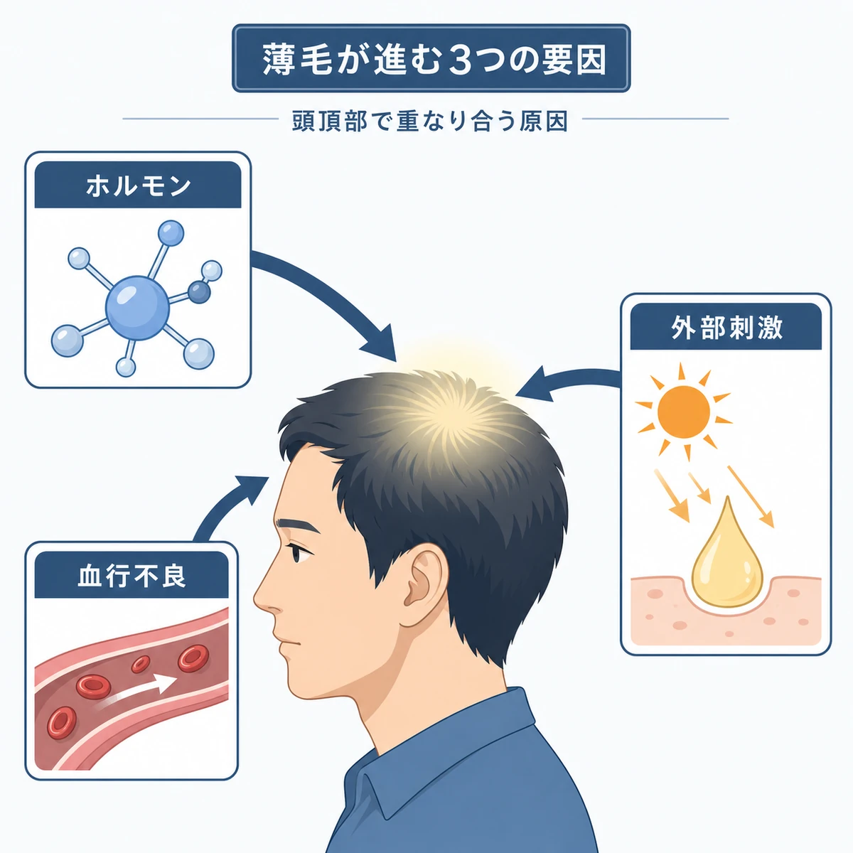 男性の頭頂部に集まるホルモン・血行不良・外部刺激の関係を表した医療イラスト