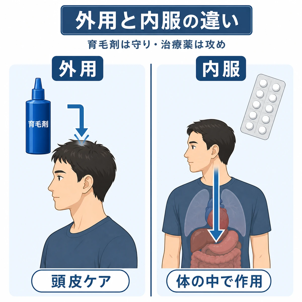 外用の育毛剤と内服のAGA治療薬で作用する場所が違うことを2パネルで対比した医療イラスト