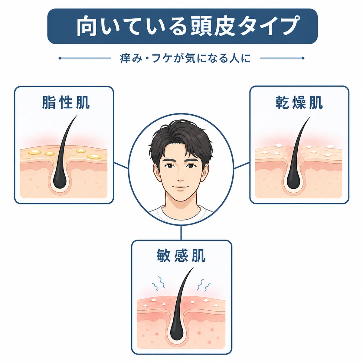 頭皮タイプ別にジフェンヒドラミン配合育毛剤が向いている人を分類した医療イラスト