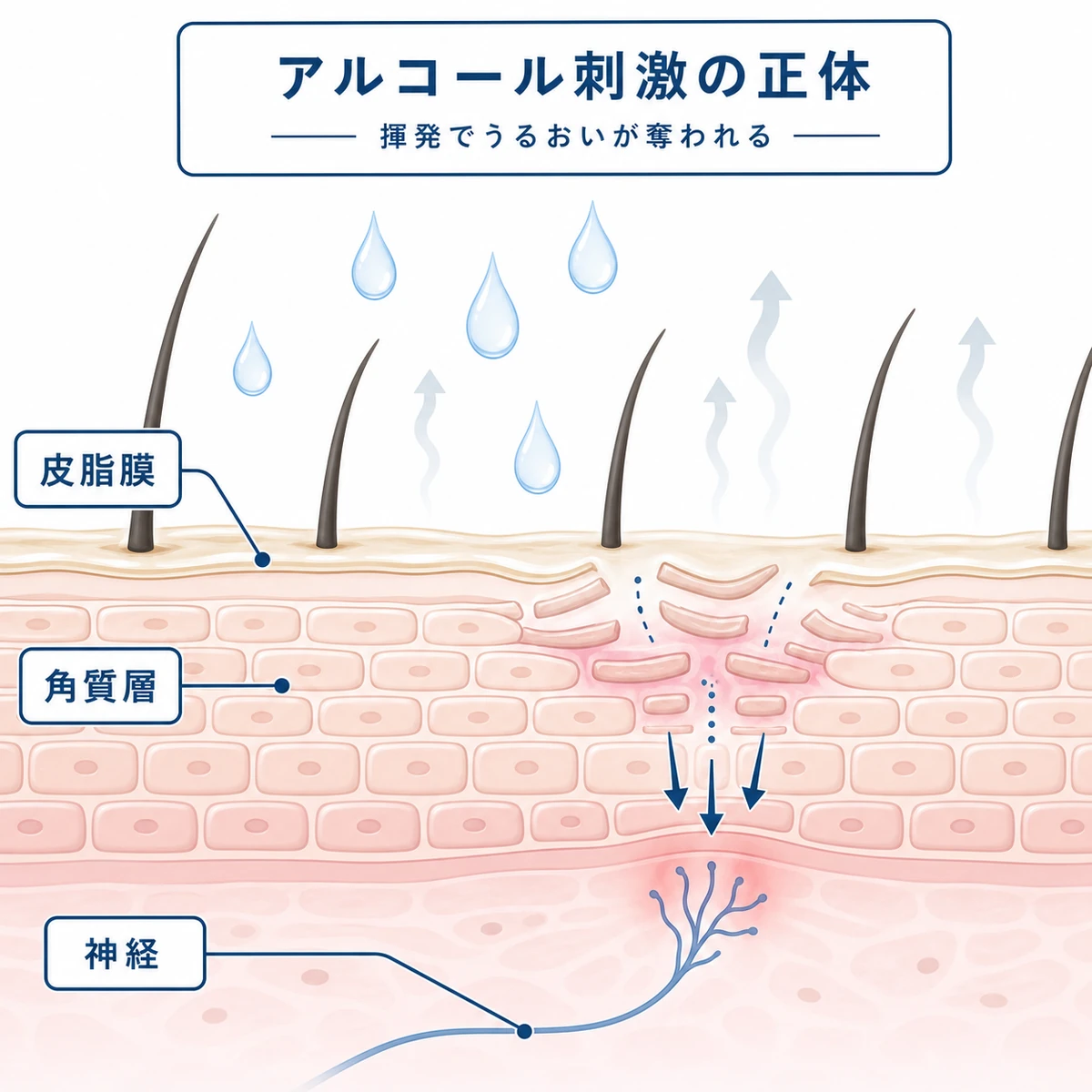 育毛剤のアルコールが頭皮のバリアを通って刺激になる仕組みを頭皮断面で表した医療イラスト