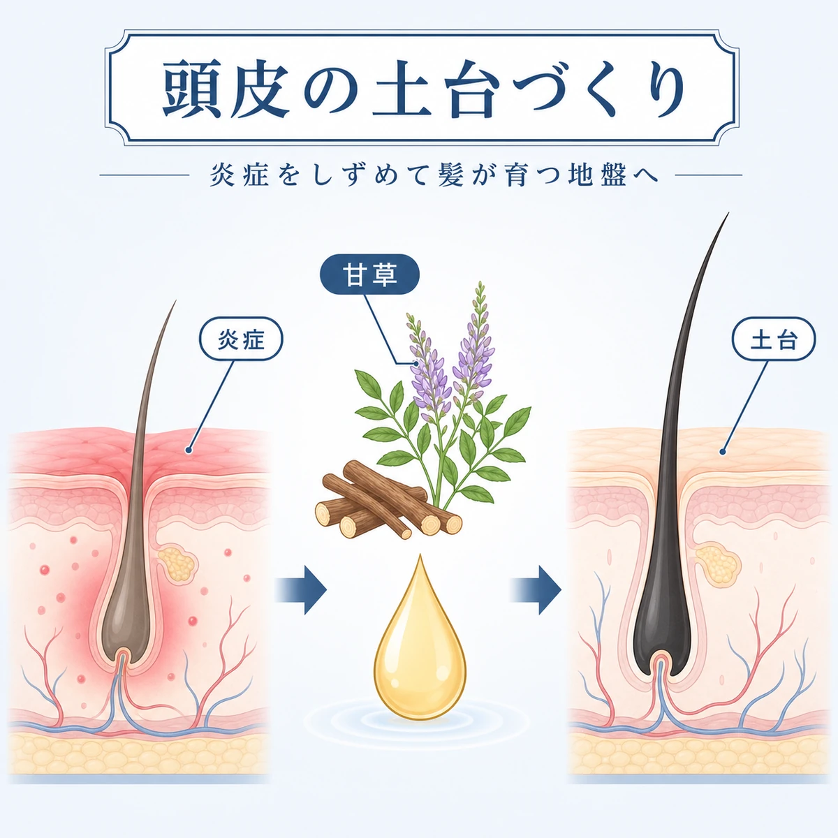 甘草由来成分が頭皮の炎症を鎮めて髪の育つ土台を整える流れを表した医療イラスト