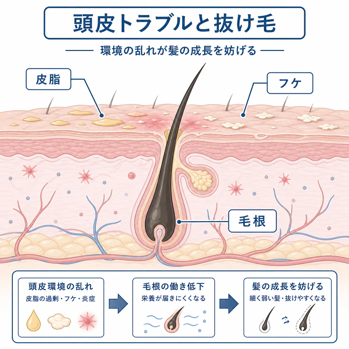 皮脂やフケなど頭皮環境の乱れが毛根を弱らせる関係を断面で表した医療イラスト