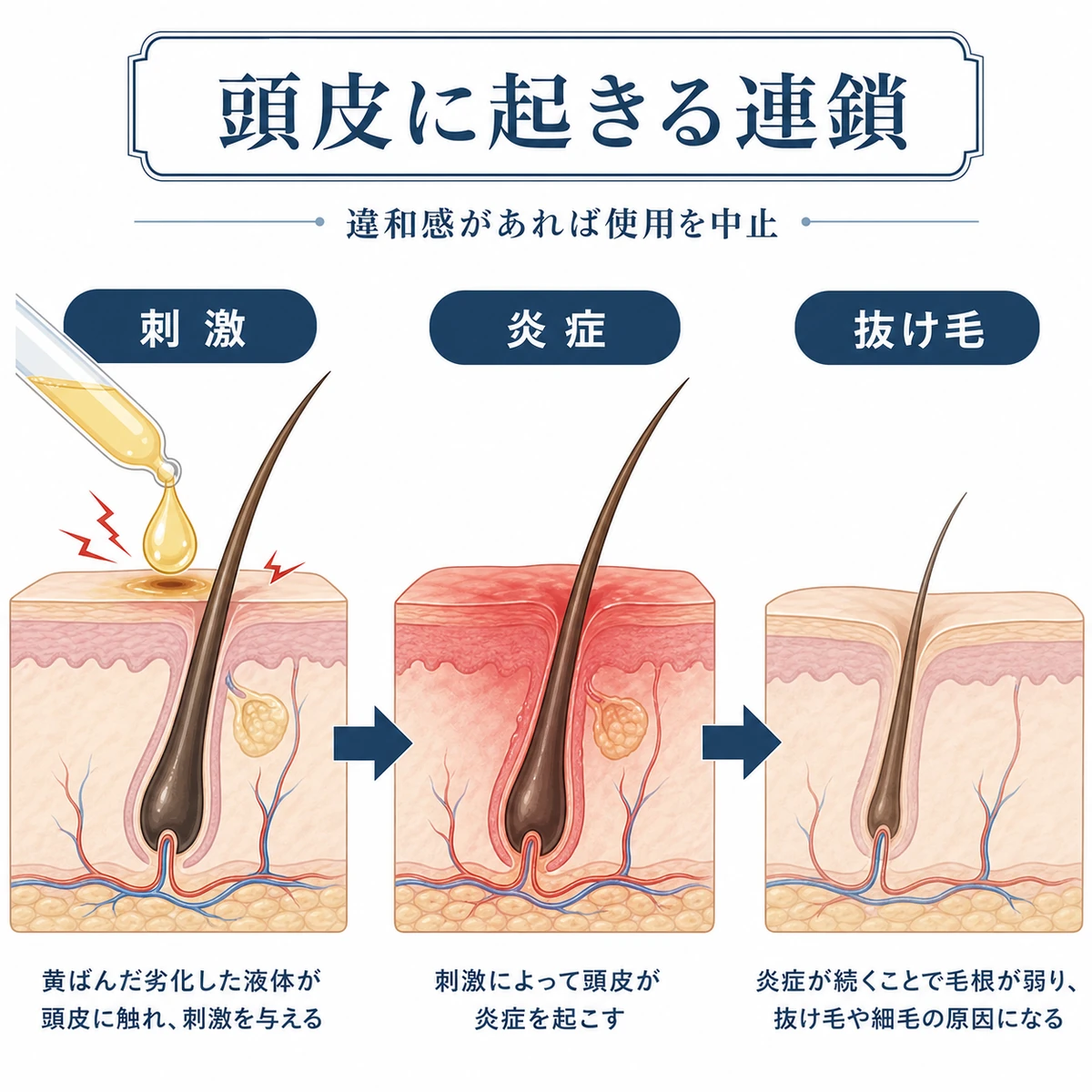 劣化した育毛剤の刺激から炎症・抜け毛へと進む頭皮トラブルの流れを表した医療イラスト