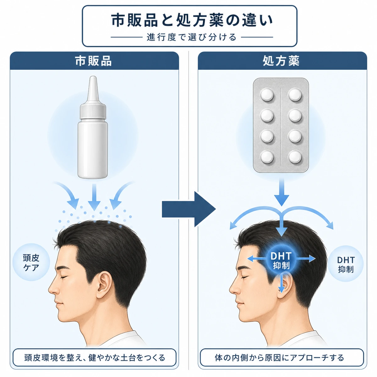 市販の育毛剤と医療用治療薬の役割の違いを左右で比べた医療イラスト