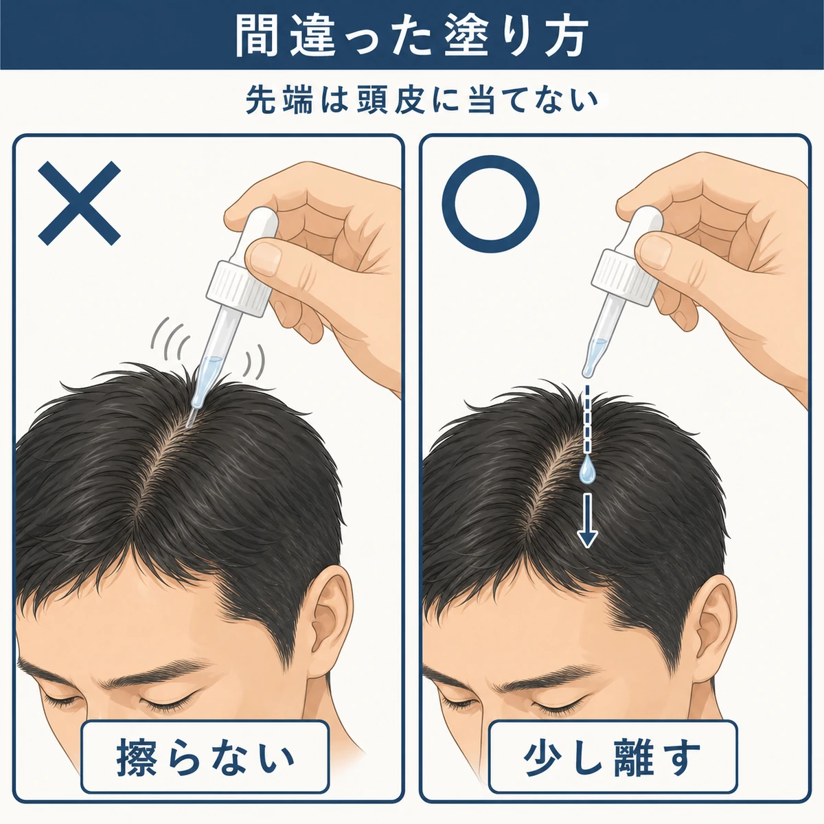 頭皮を擦るNGと先端を離すOKを対比した育毛剤の塗り方の医療イラスト
