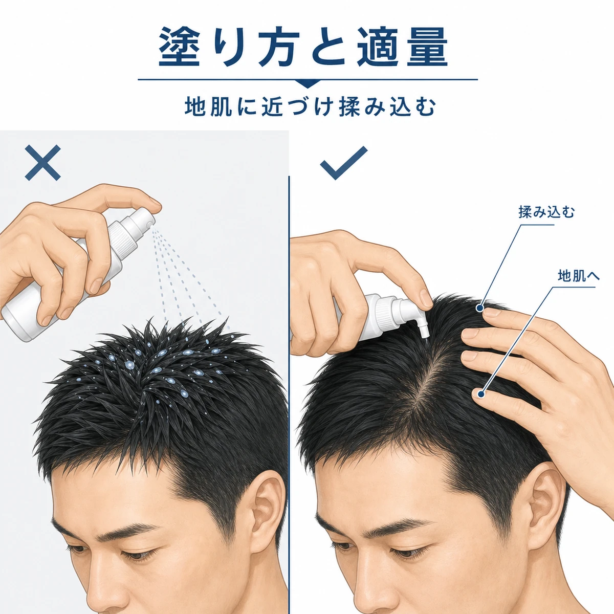 育毛剤を地肌に近づけて適量を揉み込む塗り方と塗りすぎの違いを対比した医療イラスト
