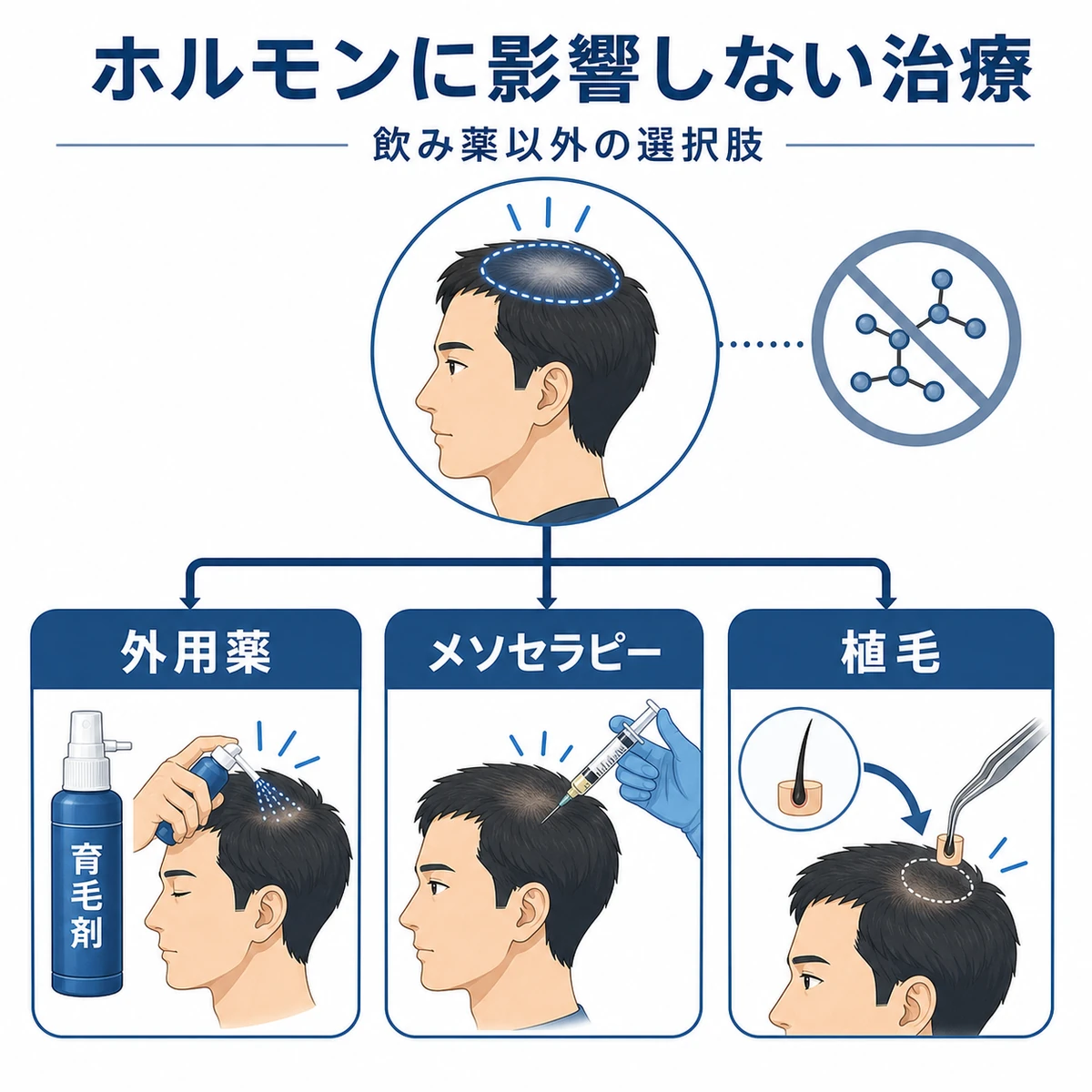 ホルモンに影響しない外用薬・注入・植毛の治療選択肢を並べた医療イラスト