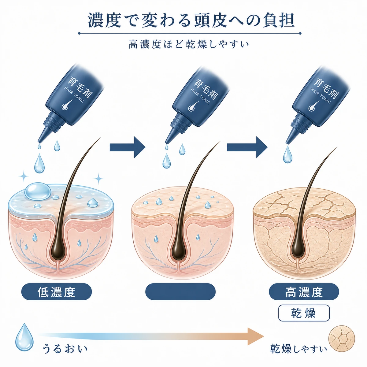 エタノール濃度が低濃度から高濃度へ上がるほど頭皮が乾燥しバリアへの負担が増える変化を左から右へ示した医療イラスト