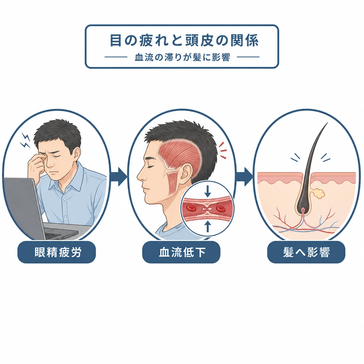 眼精疲労から血流低下を経て髪に影響するまでの流れを表した医療イラスト