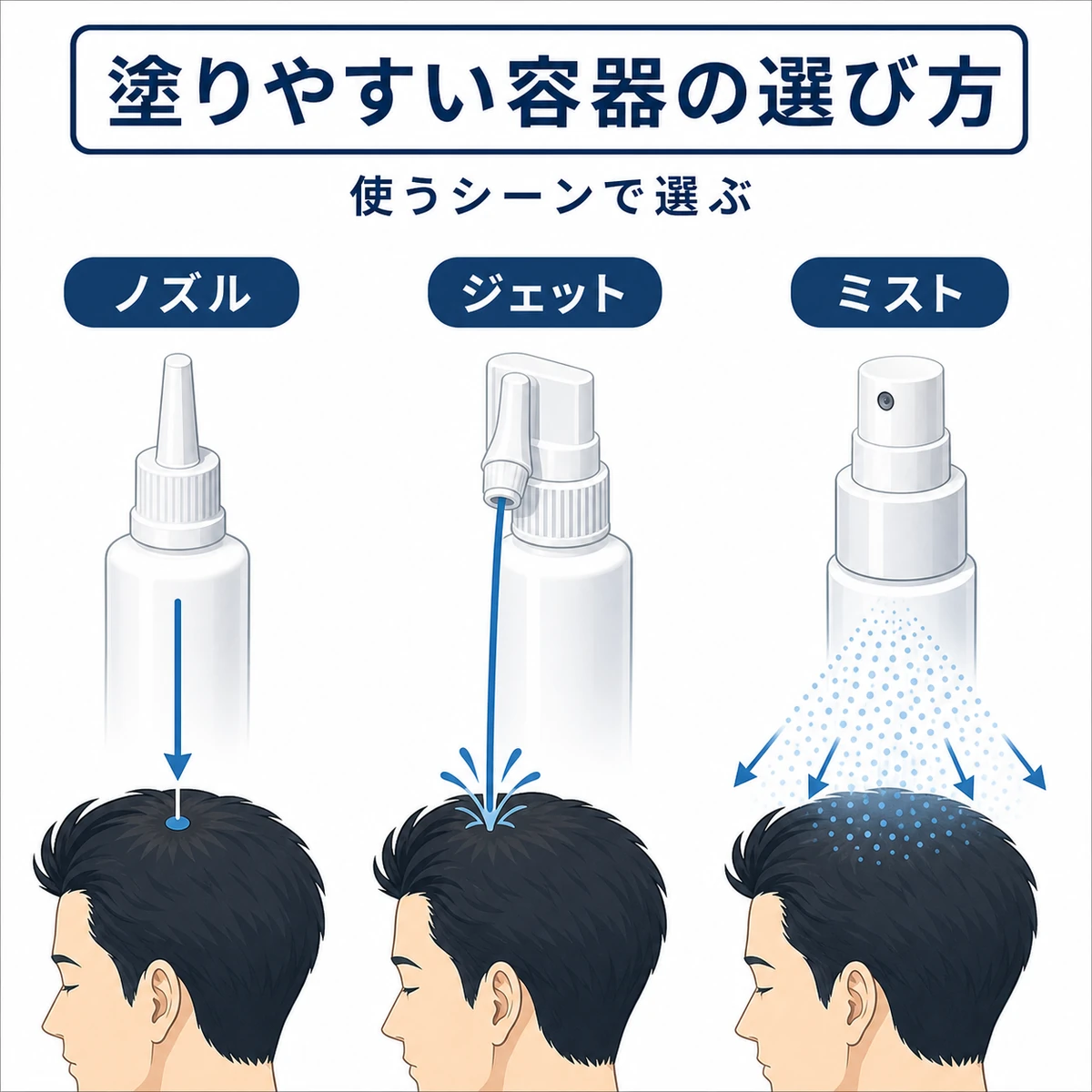 ノズル・ジェット・ミストの3タイプの育毛剤容器の違いを表した医療イラスト