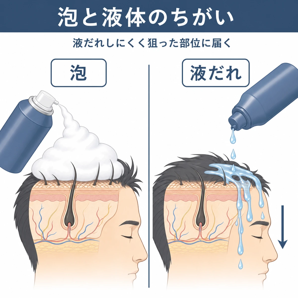 泡タイプと液体タイプの育毛剤の使用感のちがいを左右で比べた医療イラスト