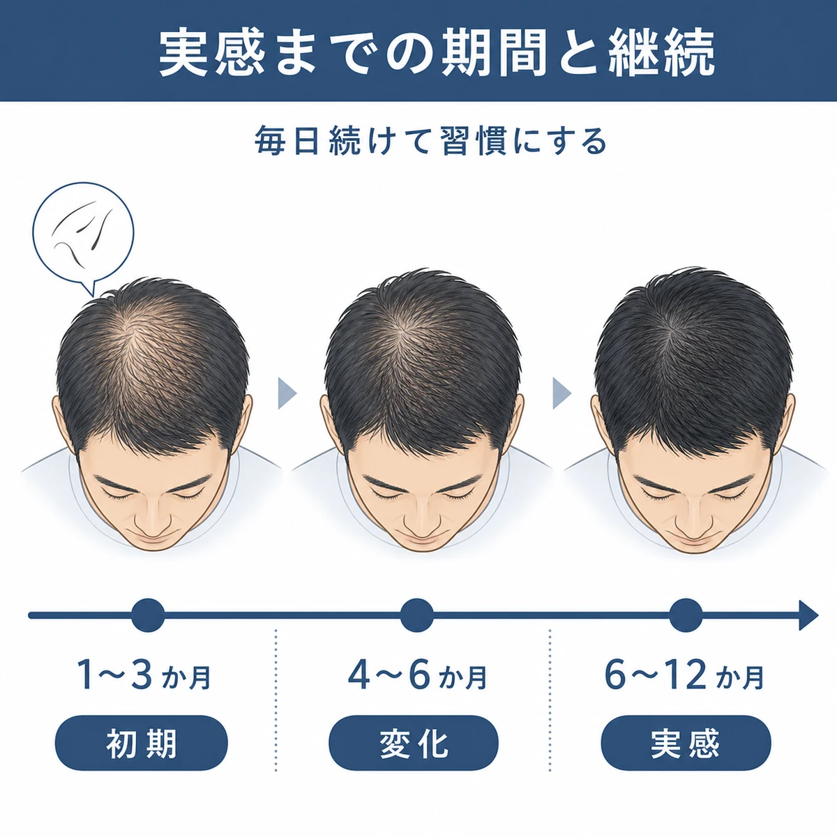 育毛剤の継続期間ごとの頭皮の変化を左から右への時間軸で示した医療イラスト