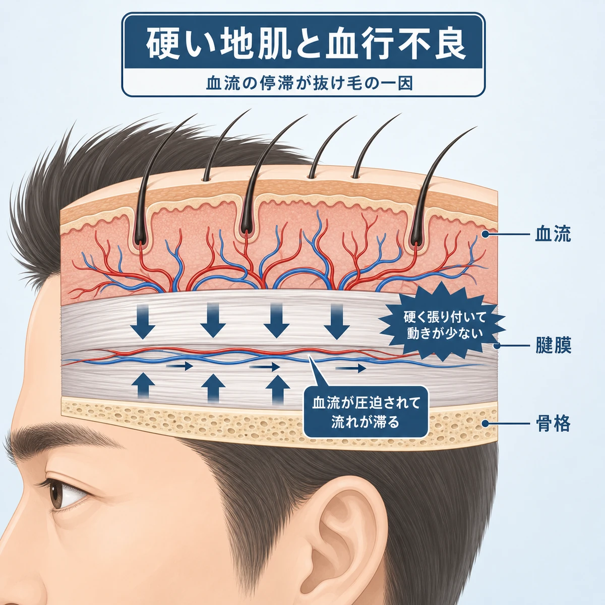 硬くなった頭皮の断面と圧迫された血流を表した医療イラスト