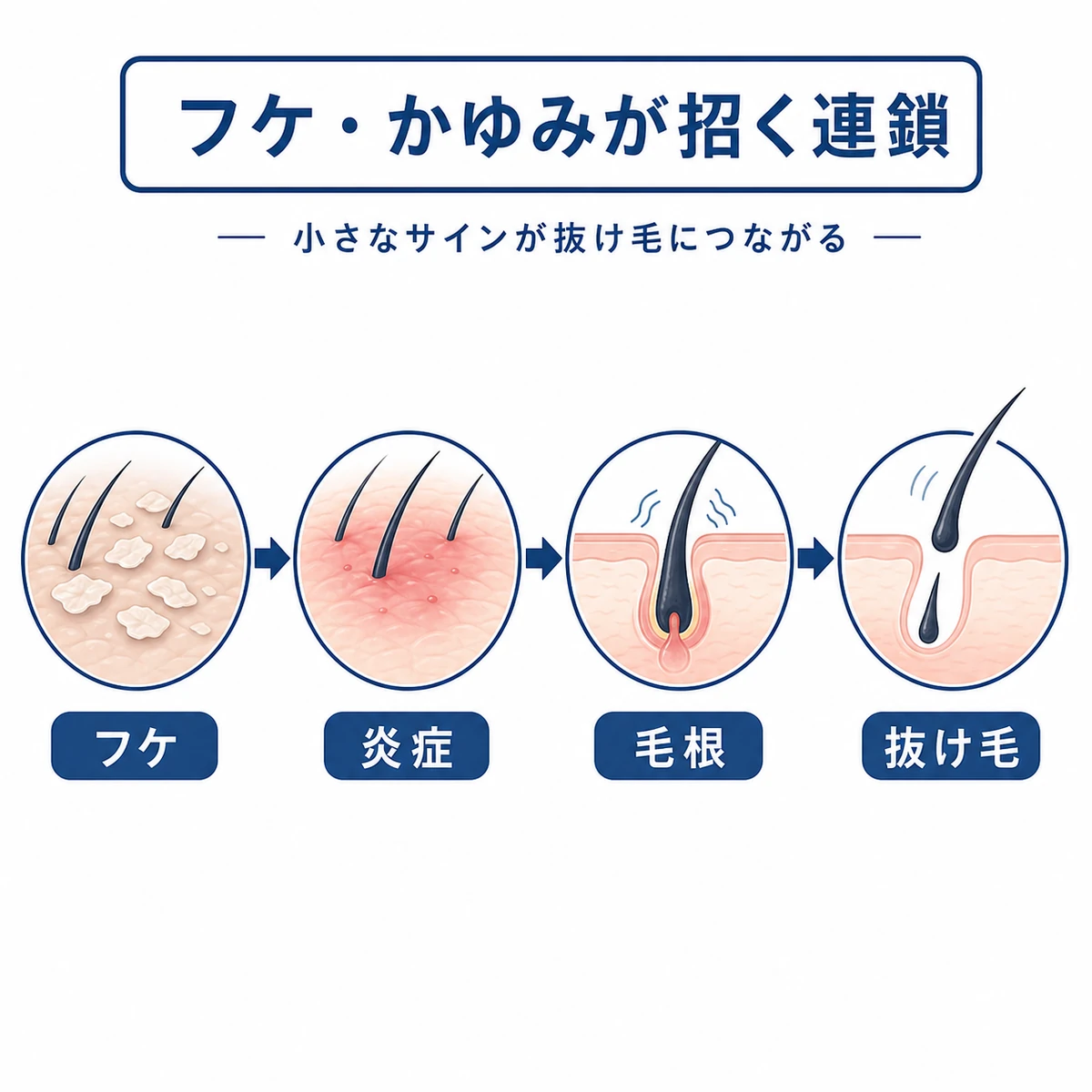 頭皮のフケやかゆみが炎症を経て抜け毛へつながる流れを段階で表した医療イラスト