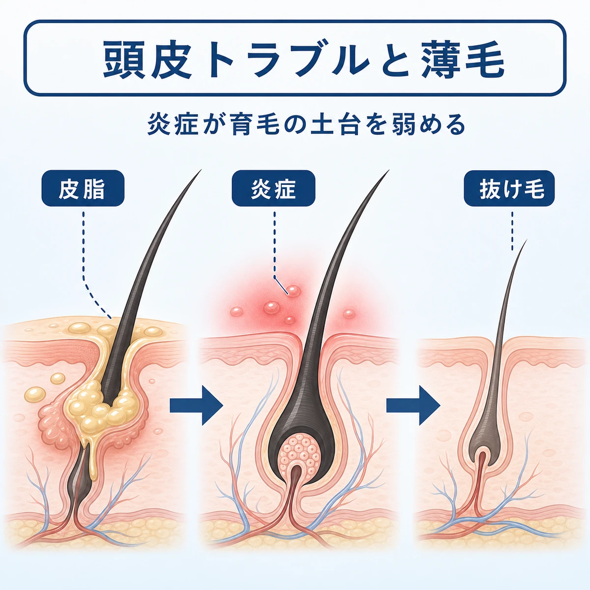 頭皮の炎症が毛根の血流を妨げ抜け毛につながる流れを表した医療イラスト
