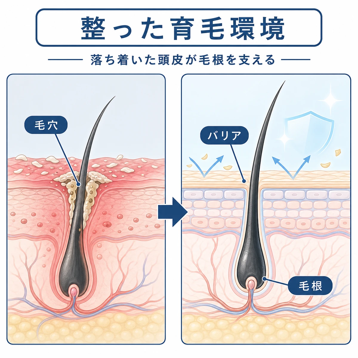 炎症が鎮まり毛穴とバリア機能が整って毛根が育ちやすくなる頭皮の変化を表した医療イラスト